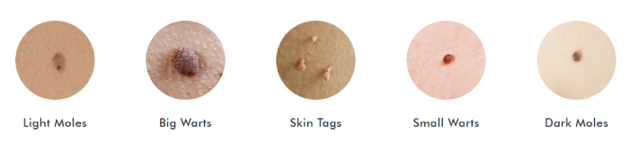 Skin Tag and moles
